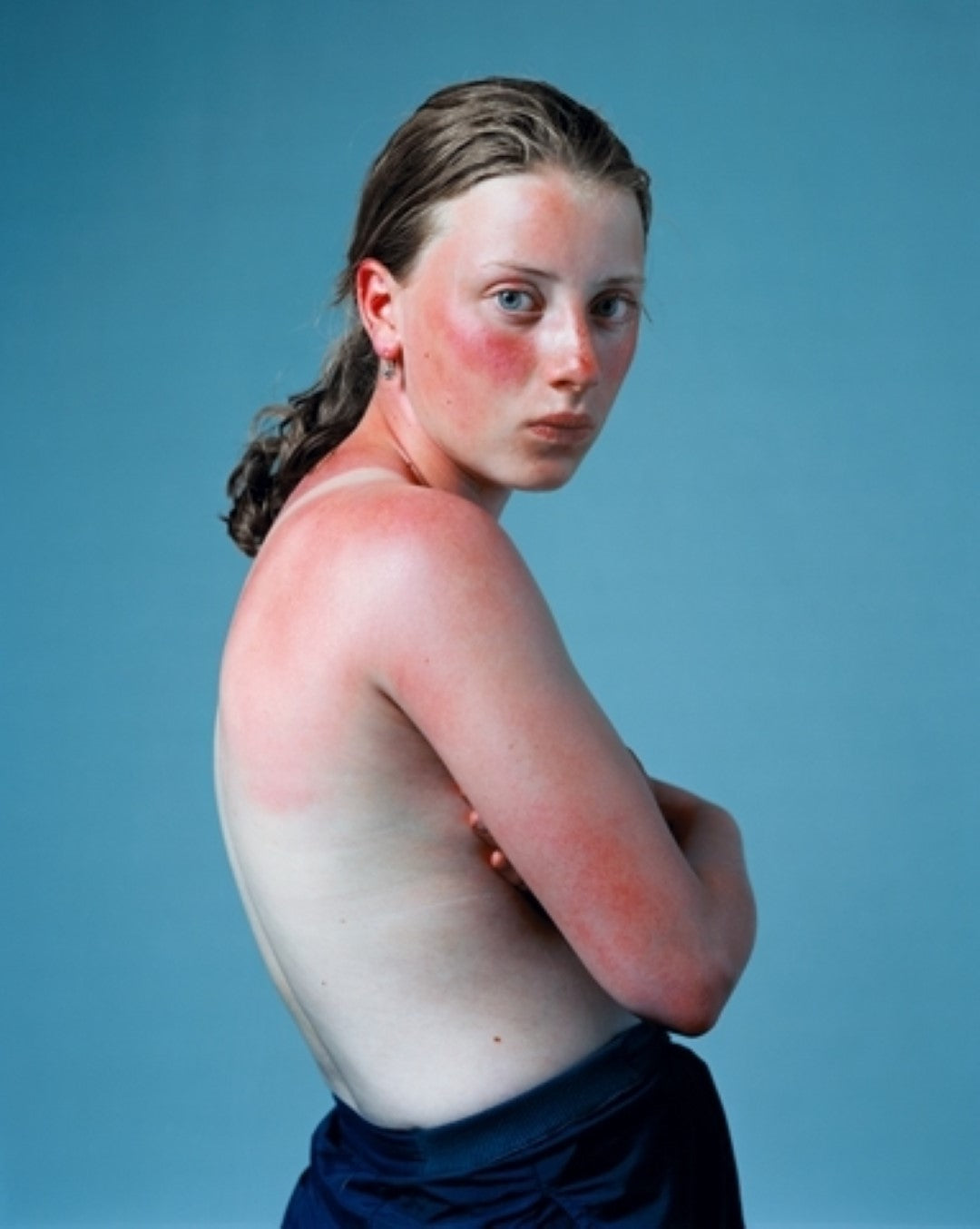 Hendrik Kerstens - Sunburned